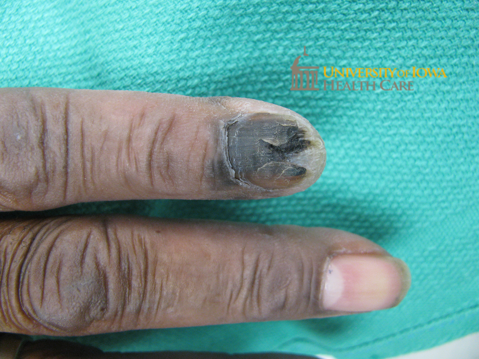 A brown and black plaque on the proximal nail fold extending onto the distal index fingertip. (click images for higher resolution).